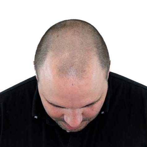 Bovenaanzicht van behandelend hoofd voor de haartransplantatie behandeling tegen kaalheid
