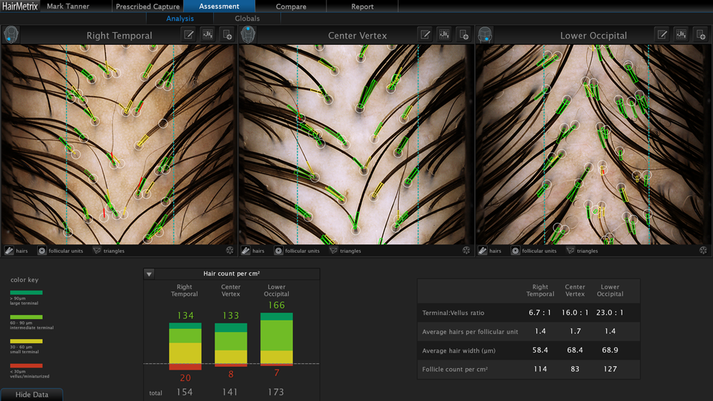 hairmetrix-analysis hairmetrix-analysis